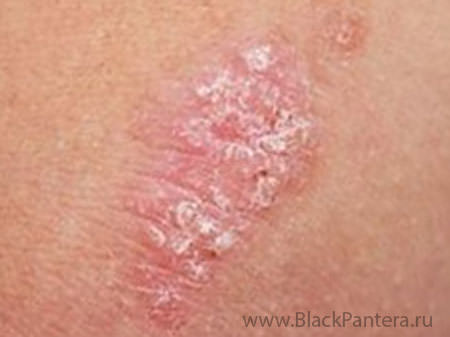 Лечение народными средствами псориаза