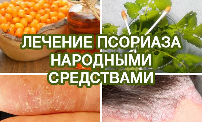 Лечение народными средствами псориаза