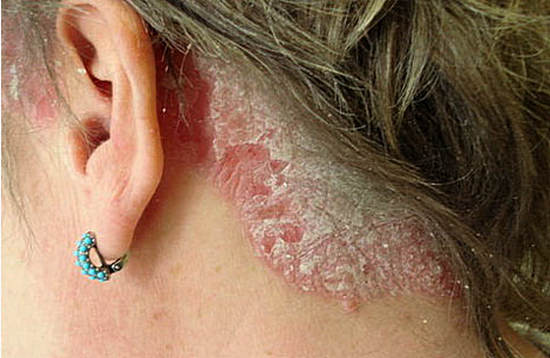 Лечение народными средствами псориаза