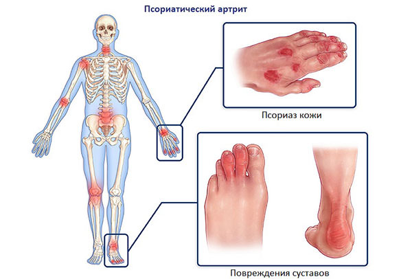 Лечение псориатического артрита