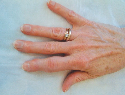 Лечение псориатического артрита