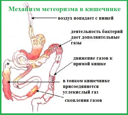 Метеоризм