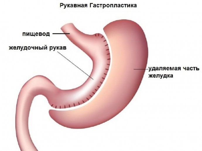 Метод рукавной гастропластики