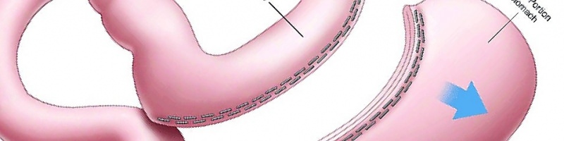 Метод рукавной гастропластики