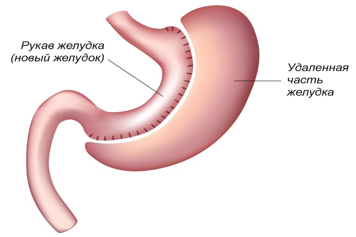 Метод рукавной гастропластики