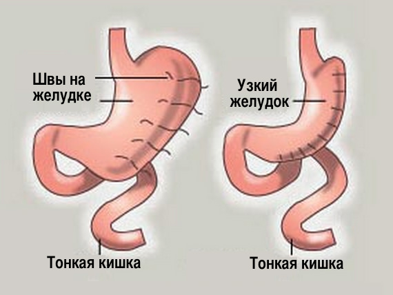 Метод рукавной гастропластики