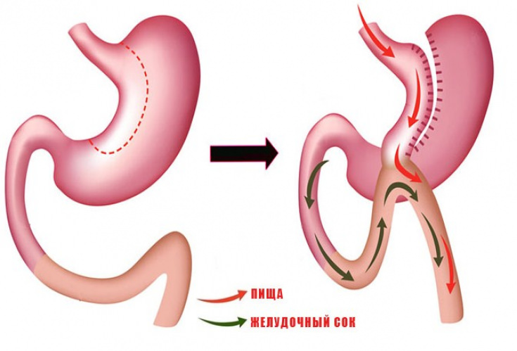 Метод рукавной гастропластики