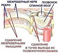 Межреберная невралгия, код по мкб 10