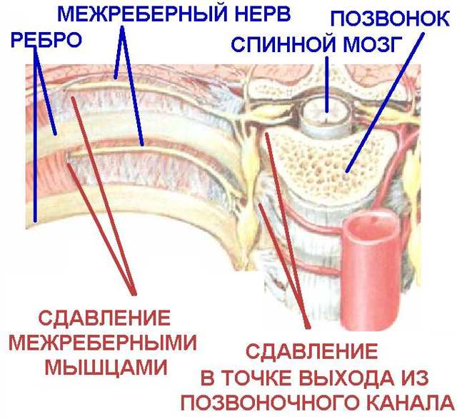 Межреберная невралгия, код по мкб 10