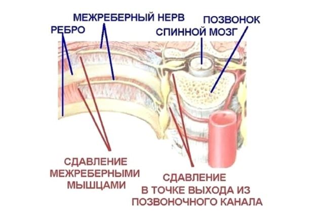 Межреберная невралгия, код по мкб 10