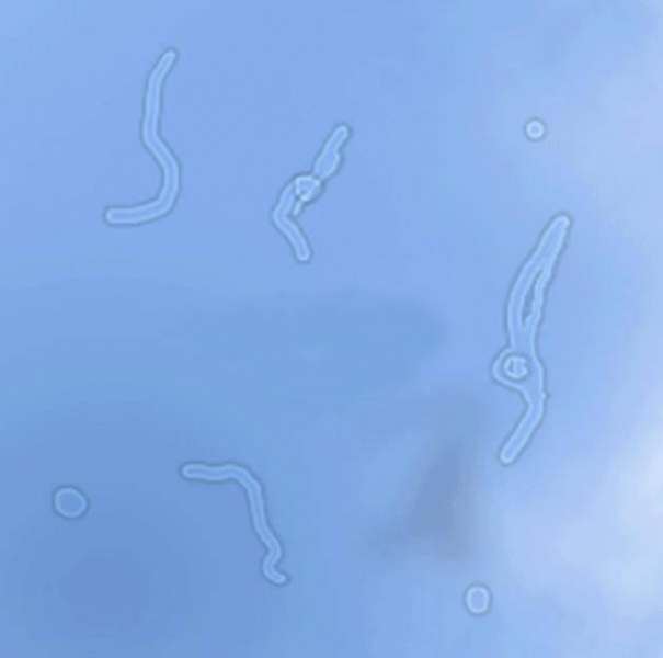 Мушки перед глазами: причины, лечение