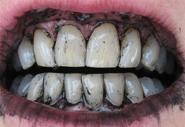 Отбеливание зубов в домашних условиях