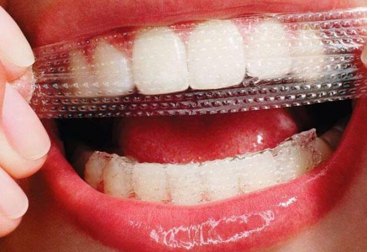 Отбеливание зубов в домашних условиях