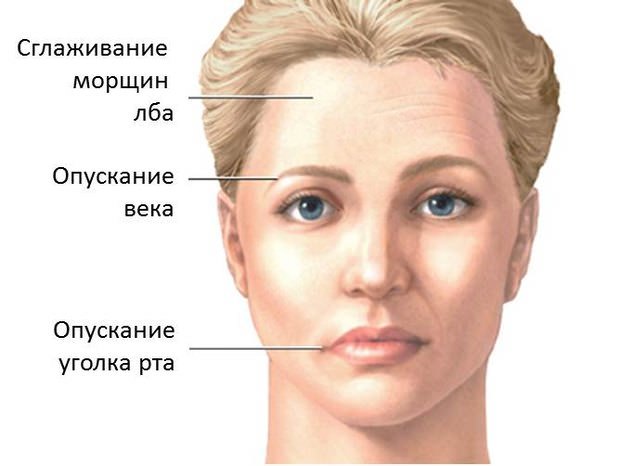 Паралич тодда и симптомы пареза