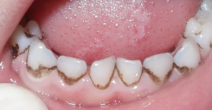 Пятна на зубах — причины, как избавиться