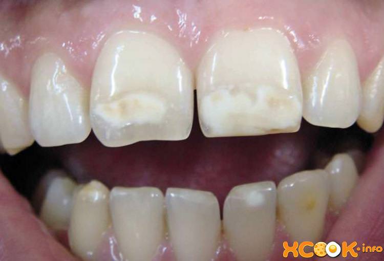 Пятна на зубах — причины, как избавиться