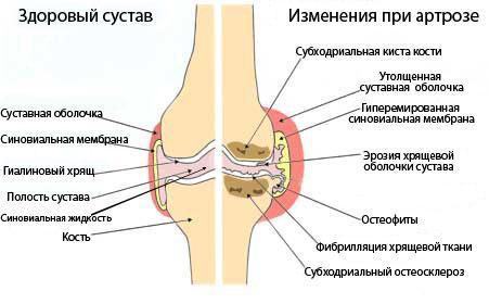 Почему при ходьбе сильно болит стопа