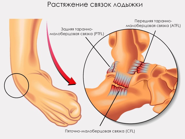 Почему при ходьбе сильно болит стопа