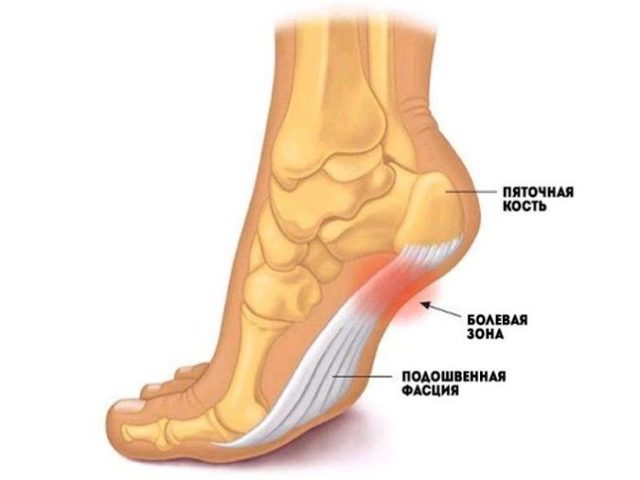 Почему при ходьбе сильно болит стопа