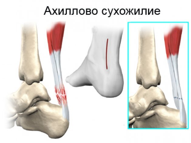 Почему при ходьбе сильно болит стопа