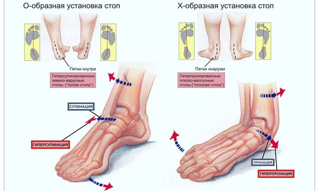 Почему при ходьбе сильно болит стопа