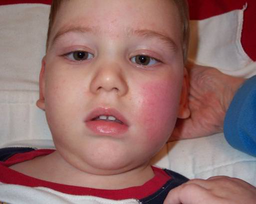 Почему щеки красные и горят