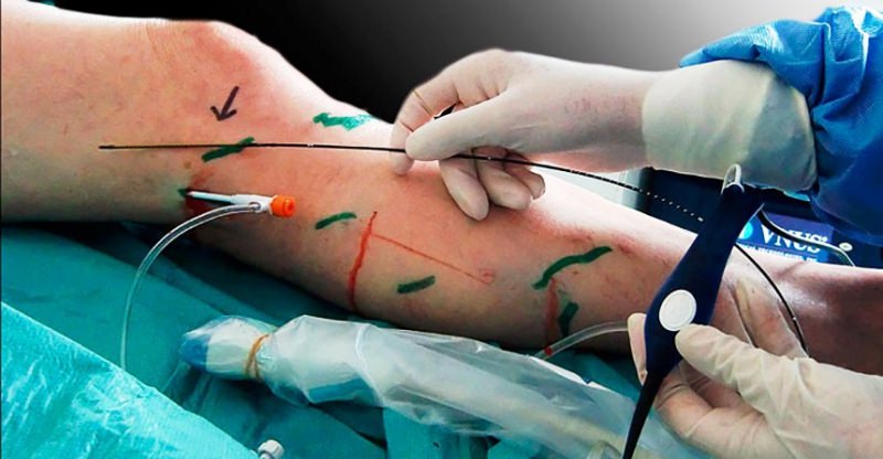 Радиочастотная абляция при варикозе