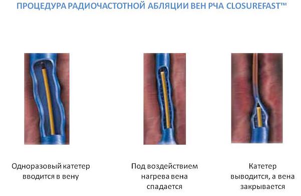Как выглядит вена после лазера