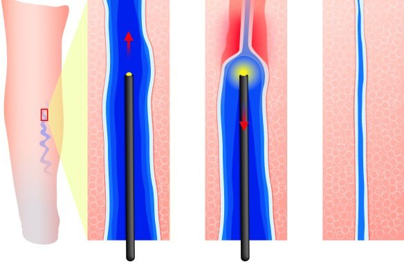 Радиочастотная абляция при варикозе