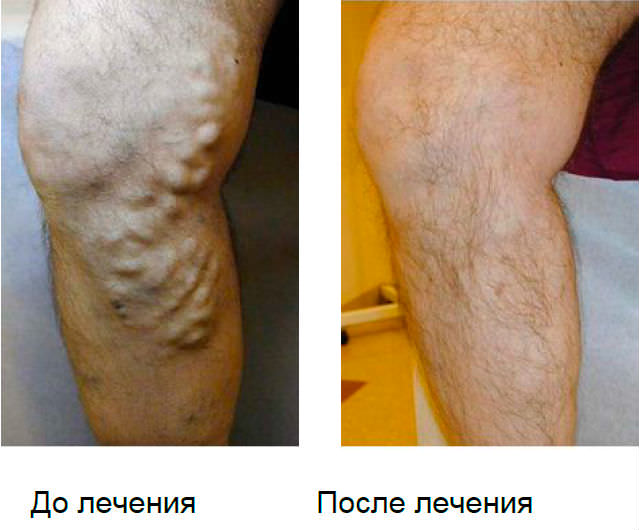 Радиочастотная абляция при варикозе