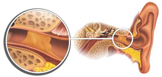 Серная пробка в ухе — что делать?