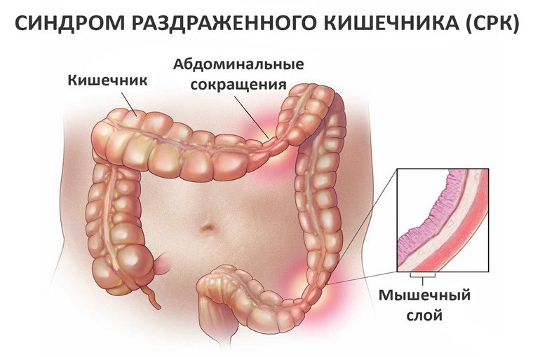 Срк: симптомы и лечение