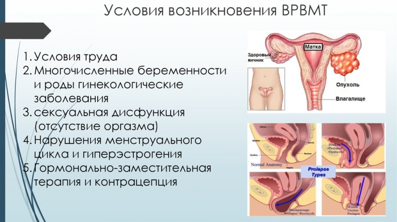 Варикоз вен малого таза (врвмт)