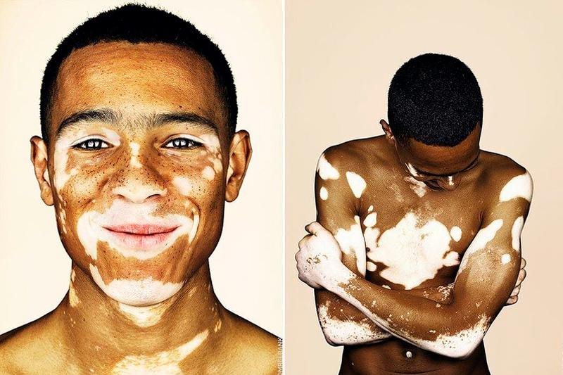 Витилиго, причины, симптомы, лечение