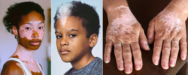 Витилиго, причины, симптомы, лечение