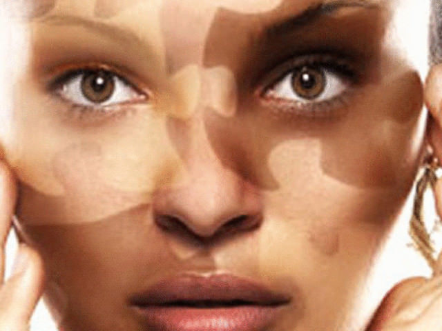 Витилиго, причины, симптомы, лечение