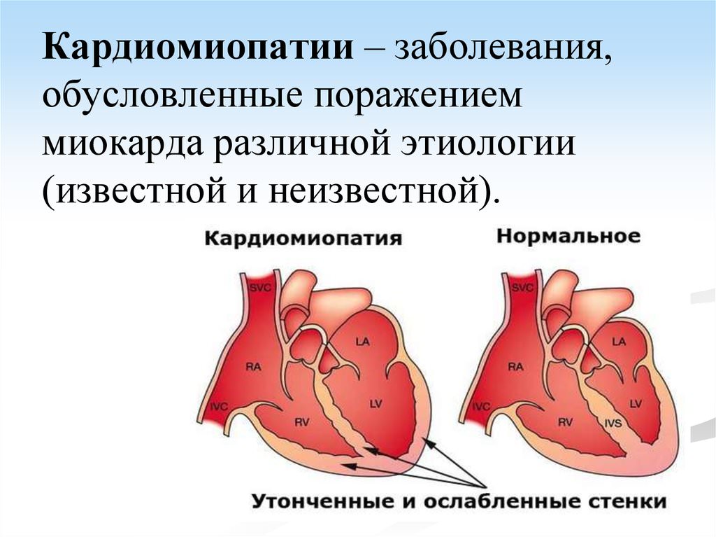 Дилатационная кардиомиопатия презентация