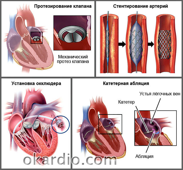 Пластика клапана. Протезирование митрального клапана, аортального клапана. Протезирование аортального клапана операция. Стентирование аортального клапана. Хирургическое лечение ХСН.