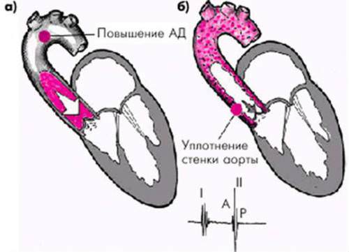 Клапан аорты створки уплотнены