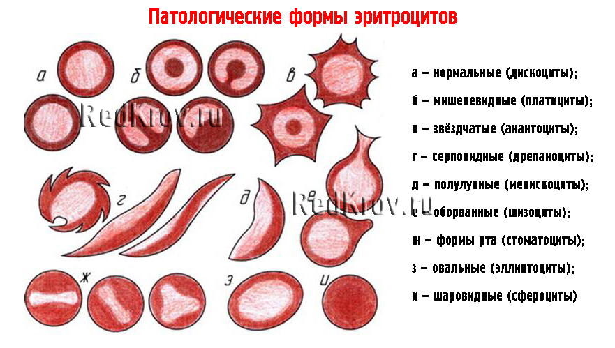 Морфологические изменения в эритроцитах рисунок