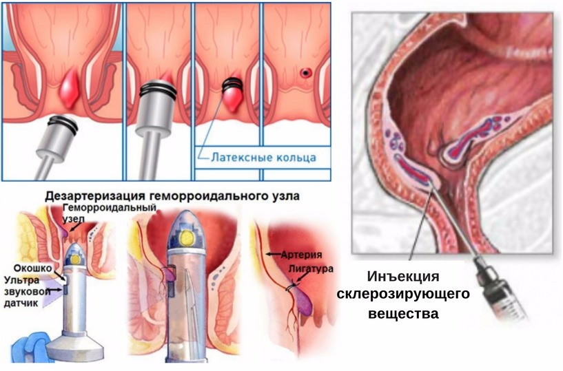 Геморрой до и после операции Перианальный венозный тромбоз - Кашель